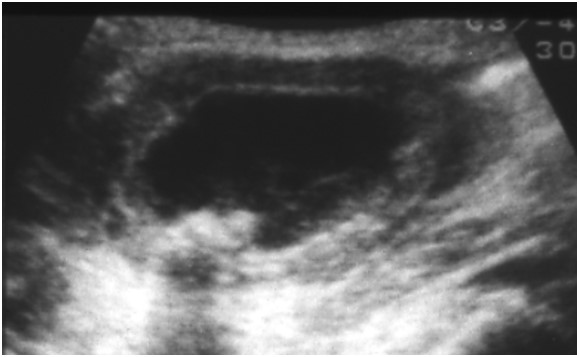 急性胆嚢炎の超音波画像