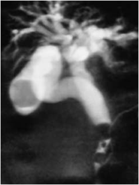 胆嚢結石、胆管結石のMRCP画像