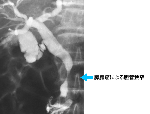 胆管狭窄