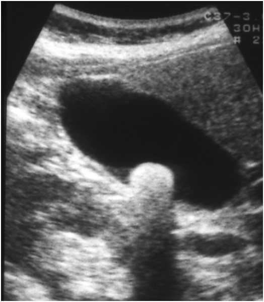 胆嚢結石の腹部超音波画像